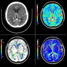 Brain CT